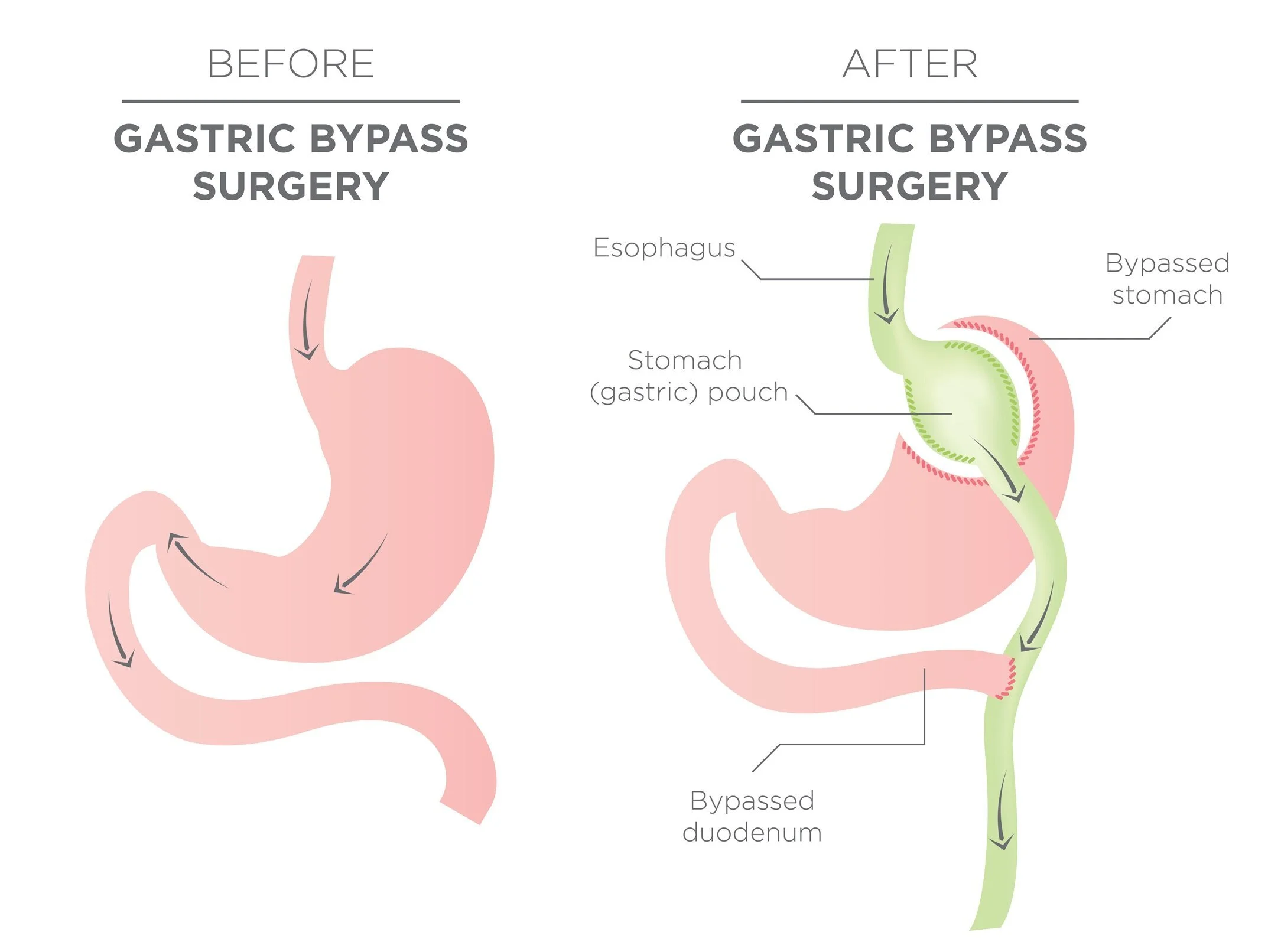gastric-bypass-body.jpg
