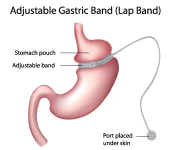 AdjustableGastricBand.jpg