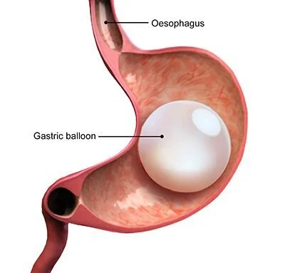 intra-gastric-balloon.jpg