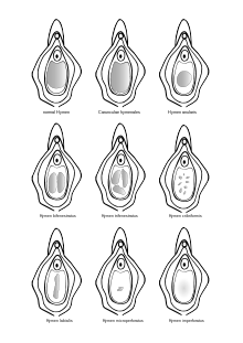 
14 things you never knew about the hymenal ring  