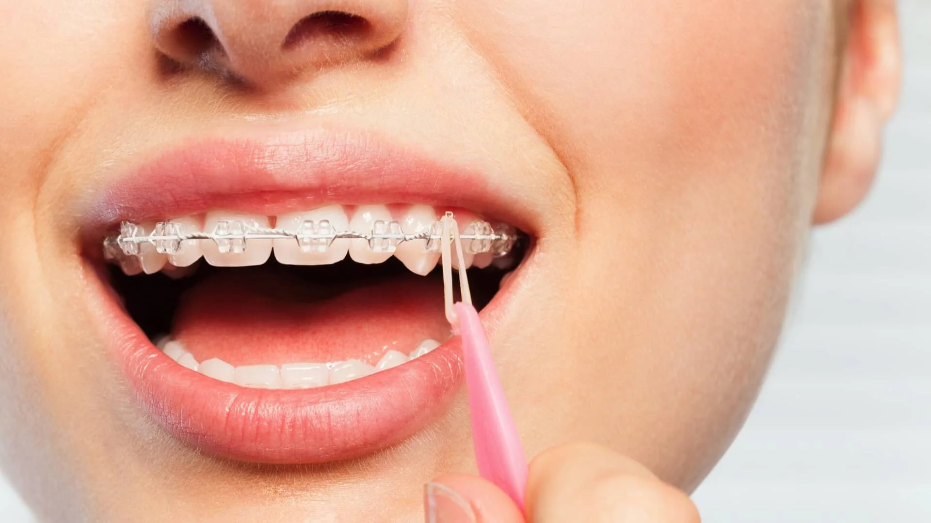 How to Use Rubber Bands for Braces 