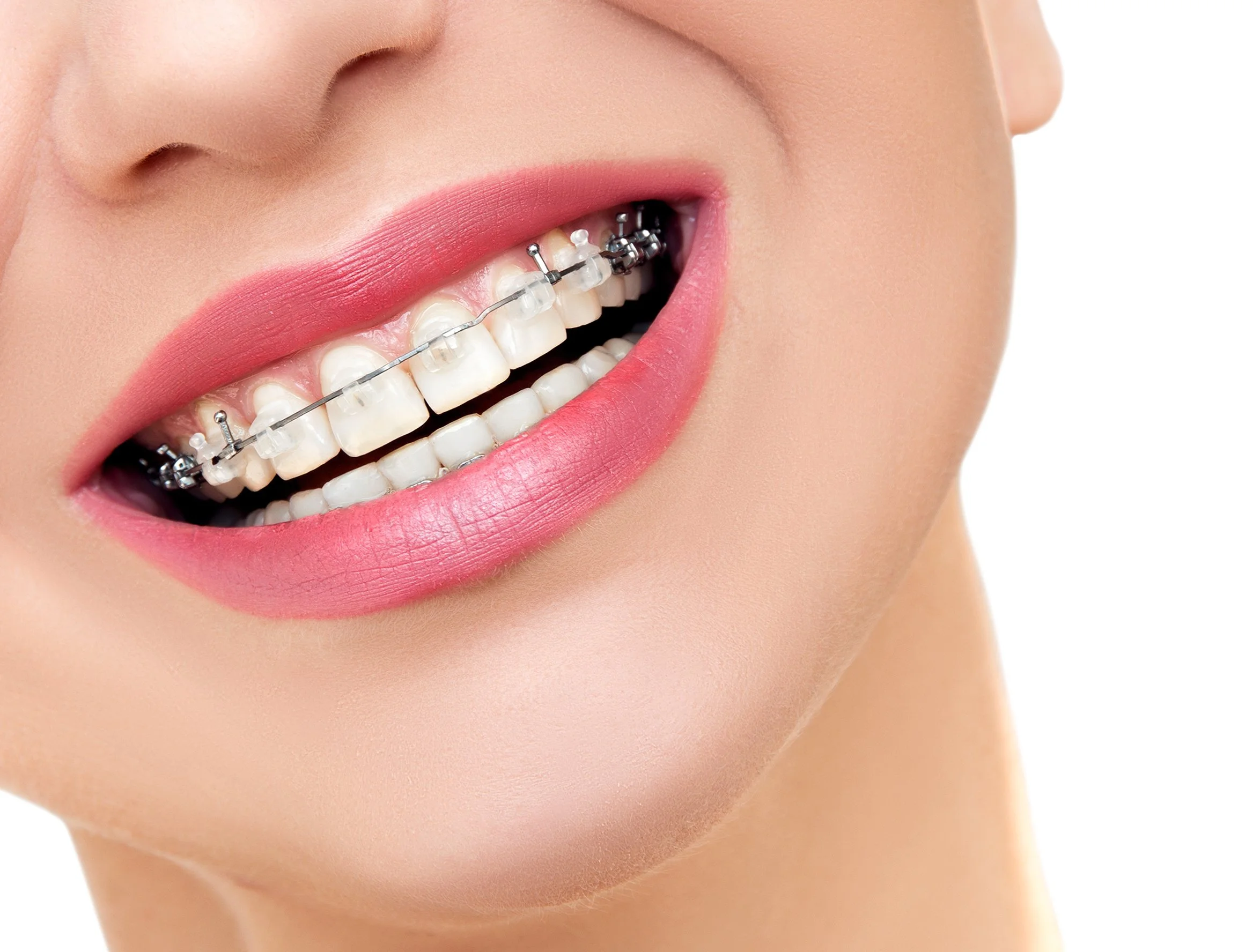 How Soon Do You See Results from Braces? 