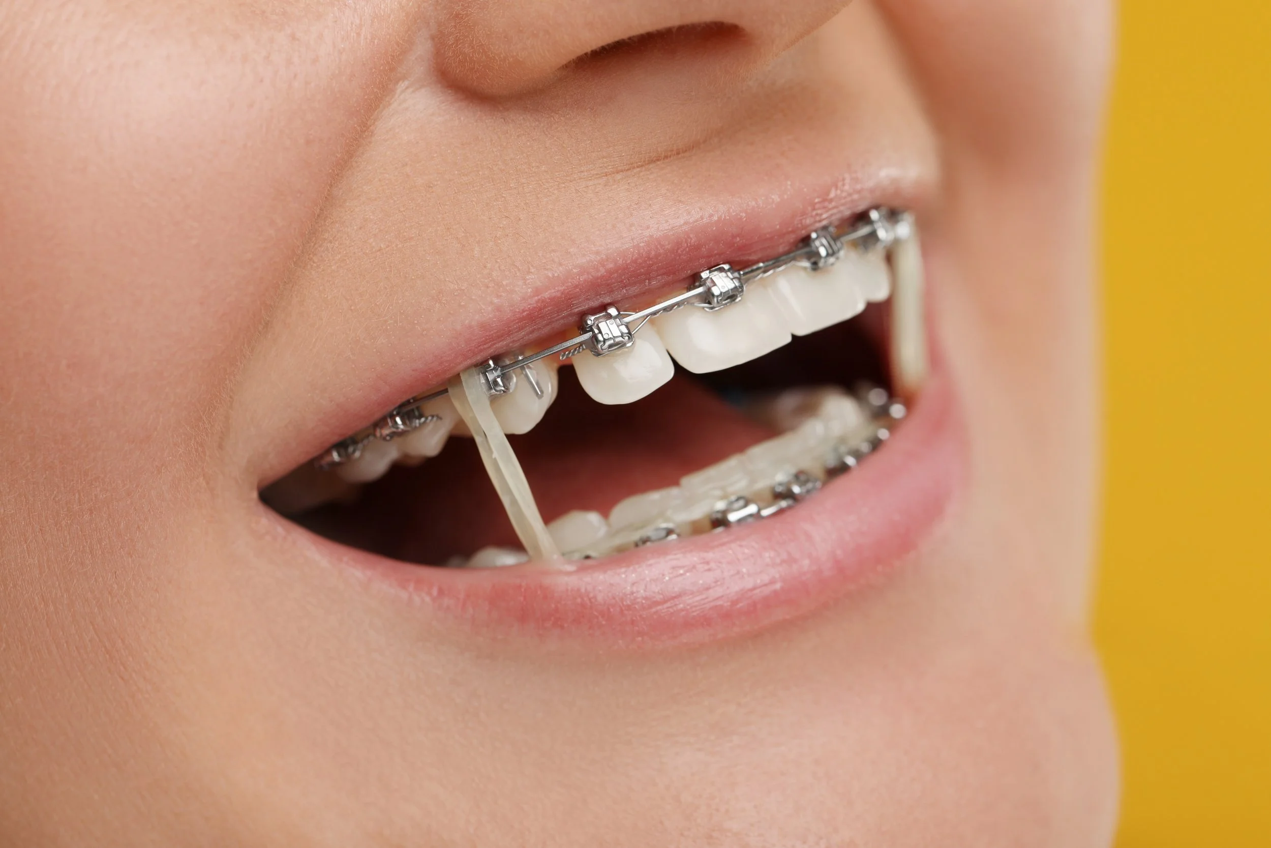 What is the hardest bite to fix with braces?