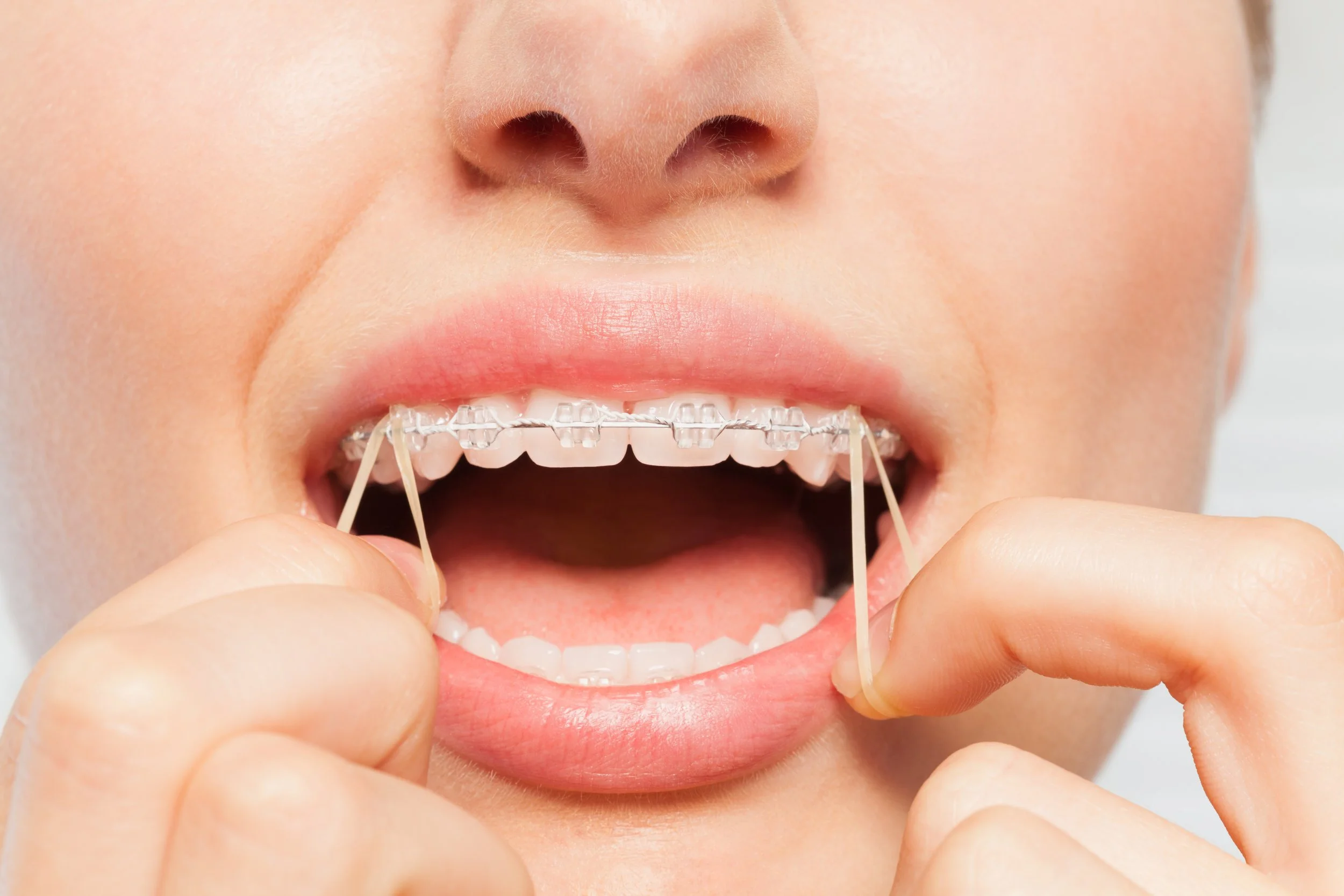 What Causes Malocclusions (Bad Bites)?