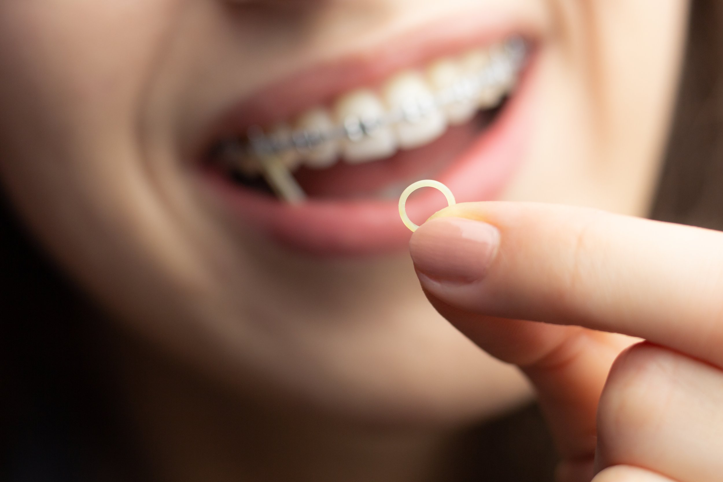 How Do Elastics Correct Your Bite?