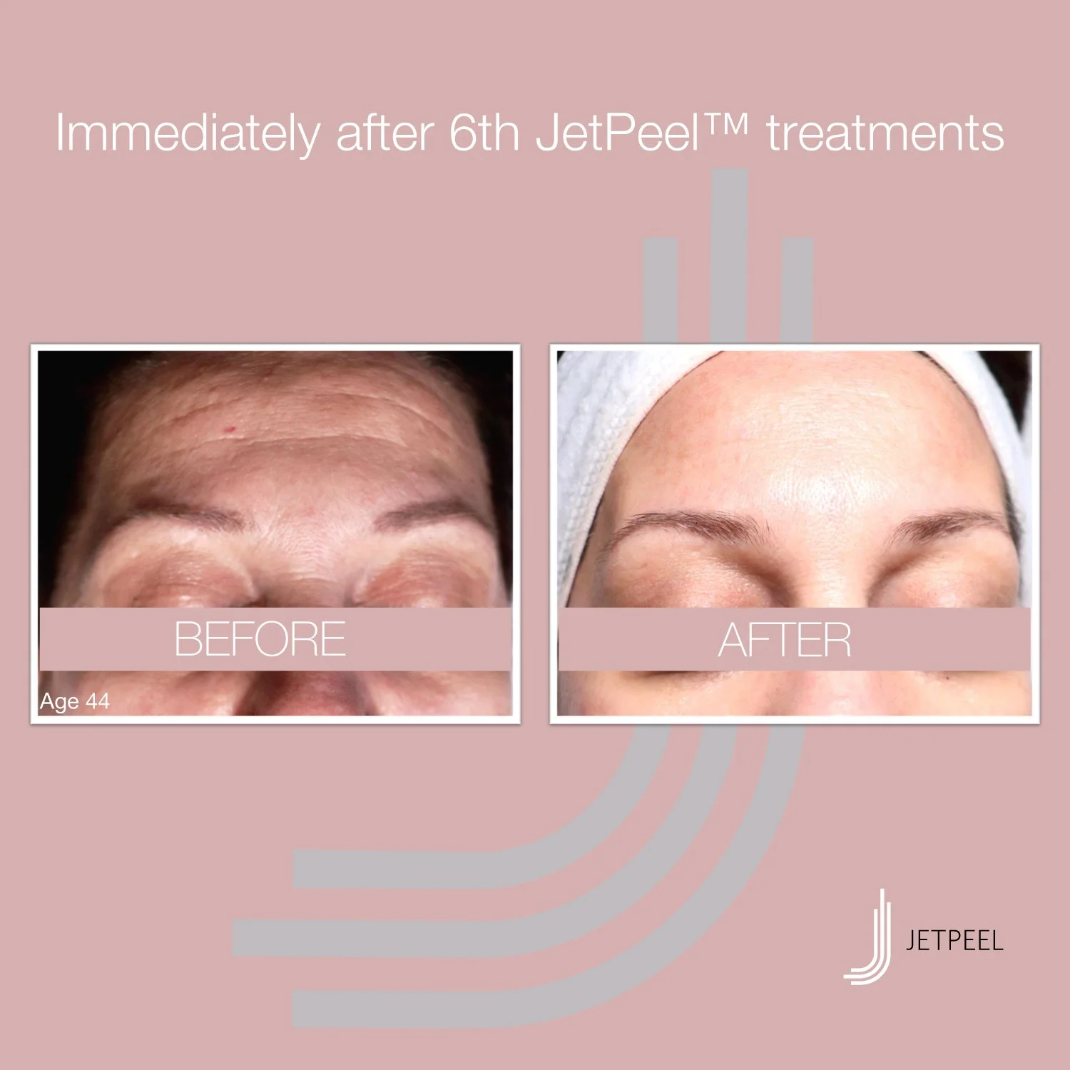 Landsberg-JetPeel-Before-After-Image-Anti-Aging-02.jpg
