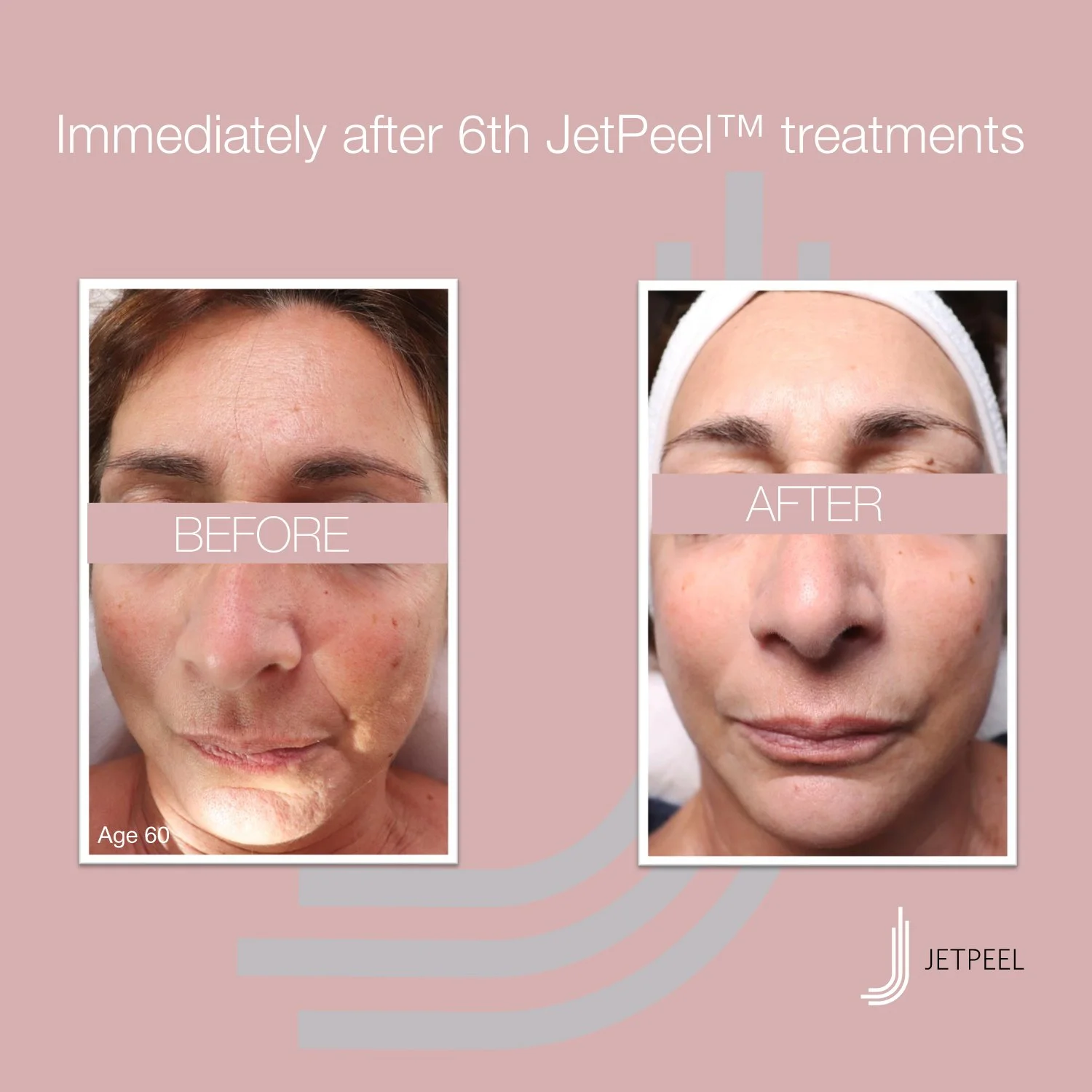 Landsberg-JetPeel-Before-After-Image-Anti-Aging-08.jpg