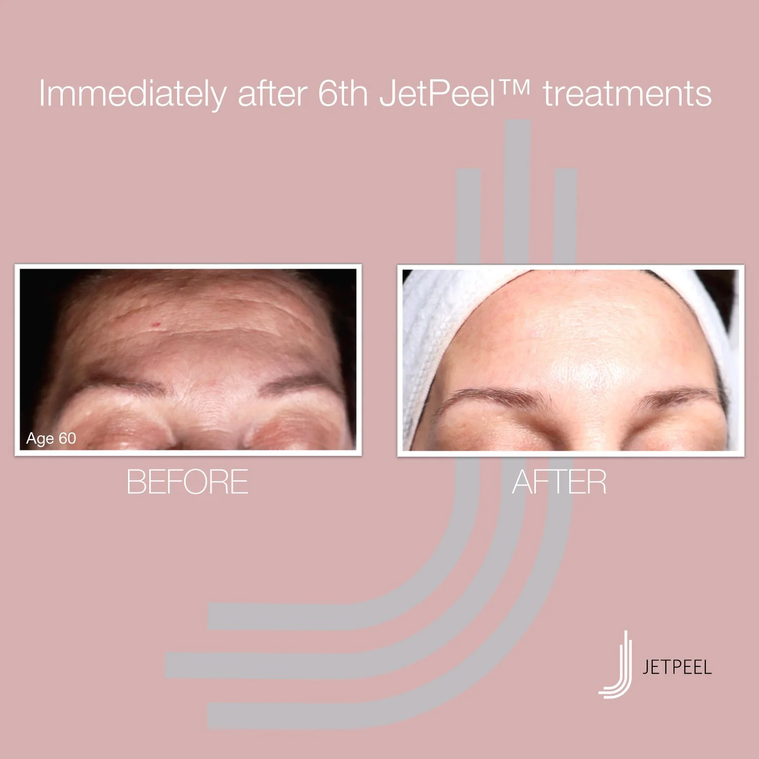 Landsberg-JetPeel-Before-After-Image-Anti-Aging-12.jpg