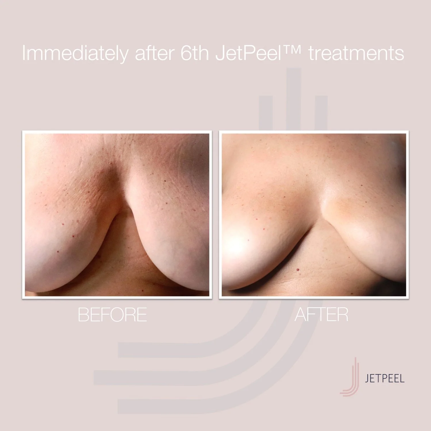Landsberg-JetPeel-Before-After-Image-Anti-Aging-Breasts-02.jpg