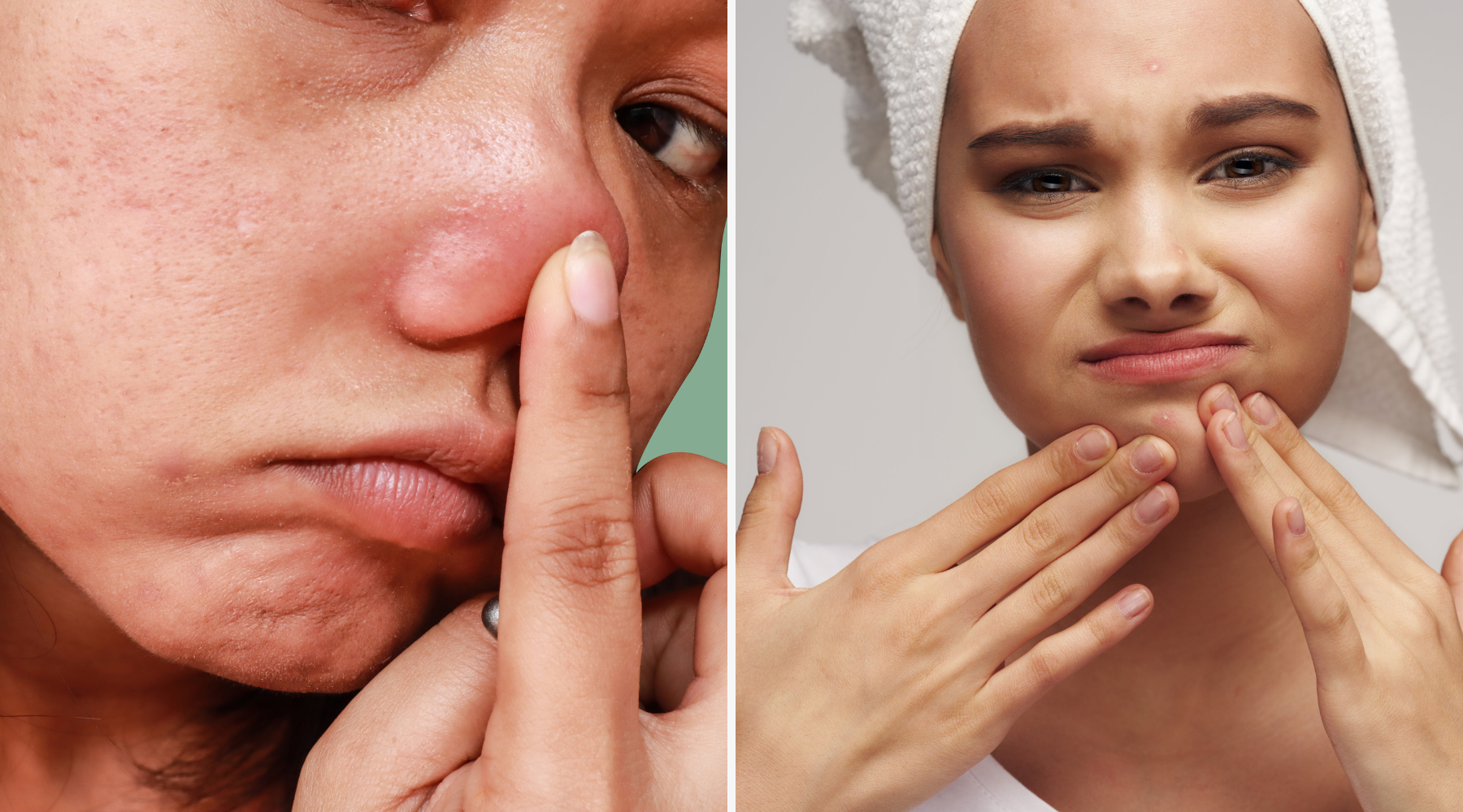 The Psychological Impact of Acne: Cultivating Self-Compassion and Resilience on the Journey to Clear Skin