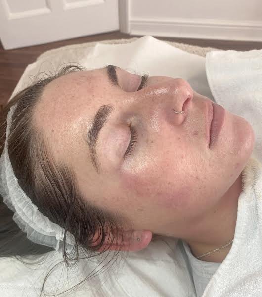 AFTER - a course of skin peels and adjusted skincare the breakouts have improved and now having micro needling to help with post mark scarring.