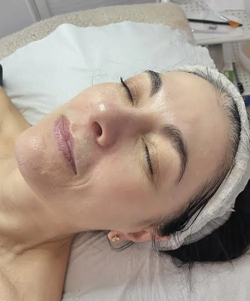 AFTER - Having a mixture of regular skin peels and micro needling the skin is looking more glowing, hydrated with a lovely tone to the skin