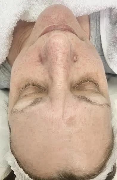 BEFORE - Clients skin appears dry, dehydrated with some redness.