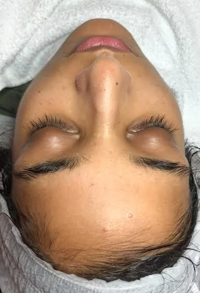 BEFORE - Clients skin concerns was breakouts and dullness