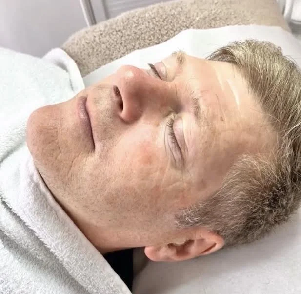 BEFORE - clients skin concerns were ageing and, redness and hyperpigmenation from sun damage 