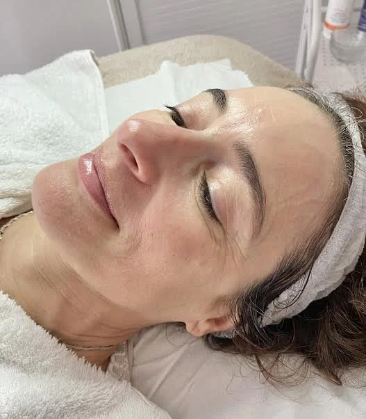 AFTER - Having regular facials and skin peels, with a new skincare regime, the clients ageing concerns has softened, with a hydrated and glowing appearance to the skin