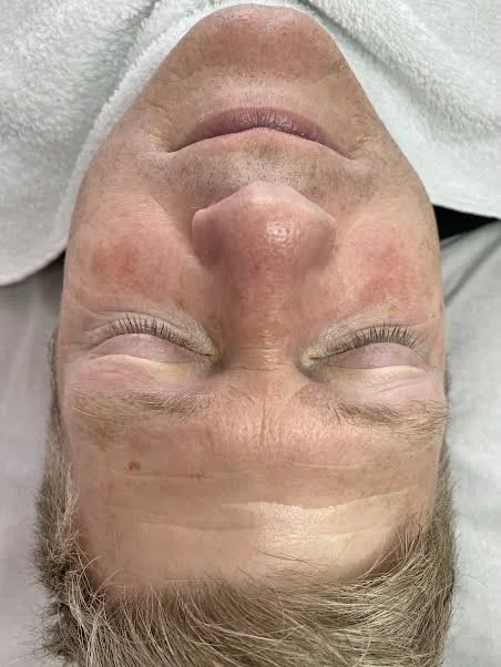 BEFORE - clients skin concerns was redness and uneven skin tone from sun damage 