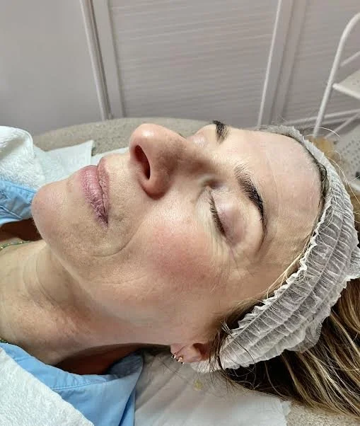 BEFORE - clients skin concerns was ageing and dehydration