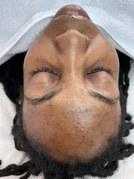 BEFORE - clients concerns were acne breakouts, hyperpigmentation and uneven skin tone