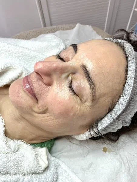 BEFORE - Clients skin concerns was early signs of ageing