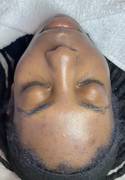 AFTER - Having a course of skin peels the skin has less breakouts, with a brighter skin tone