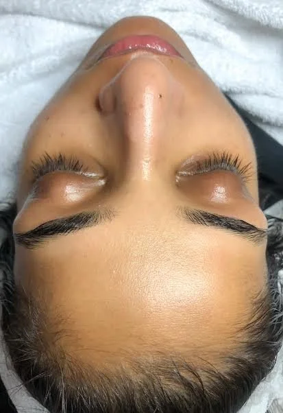 AFTER - having regular skin peels and LED light therapy the skin looks brighter with no breakouts 