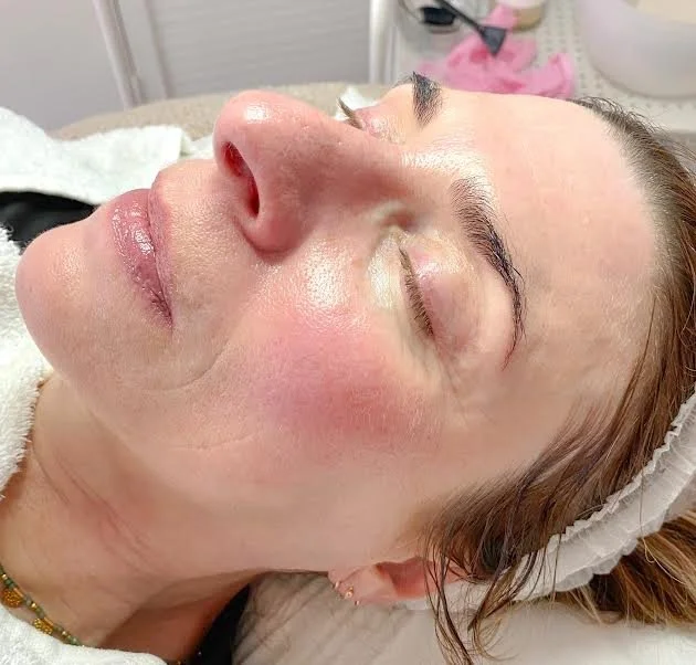 AFTER - having regular skin peels and LED light therapy the skin in looking brighter, with softened fine lines and wrinkles