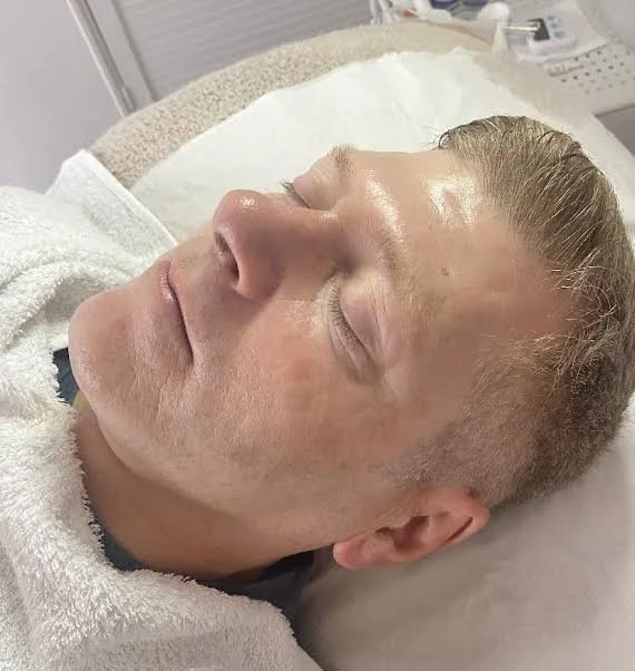 AFTER - having regular skin peels the skin looks hydrated with the pigmentation being lightened 