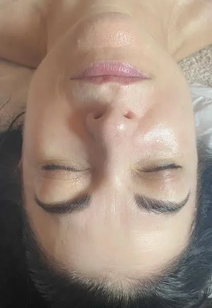 AFTER - having regular skin peels and micro needling the skin looks more even toned, brighter 