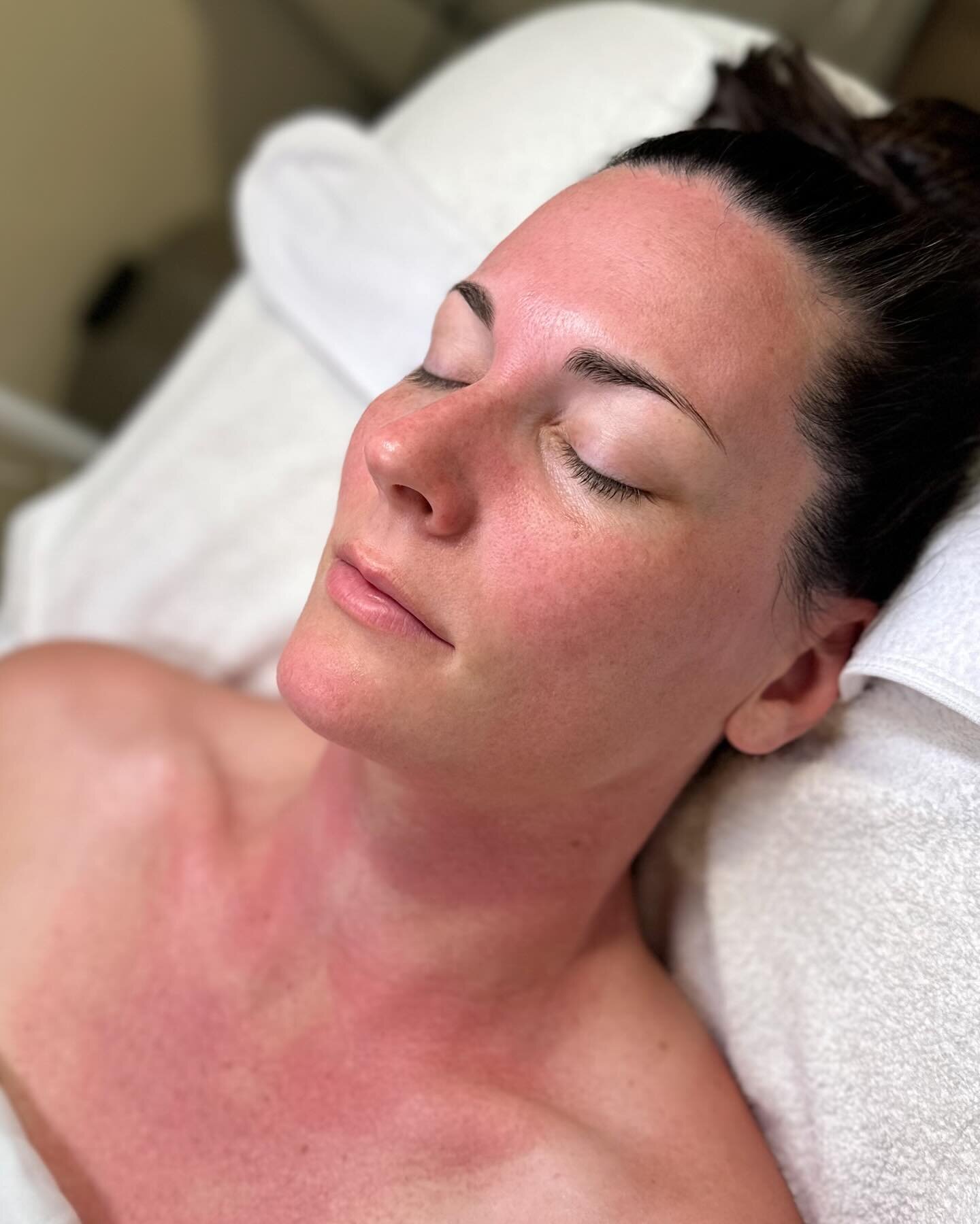 Look at that post microchanneling ✨gowl✨

ProCell Microchanneling offers amazing benefits in skin tightening and reduces wrinkles and acne scars all with minimal downtime! This treatment is much more gentle than traditional microneedling while provid