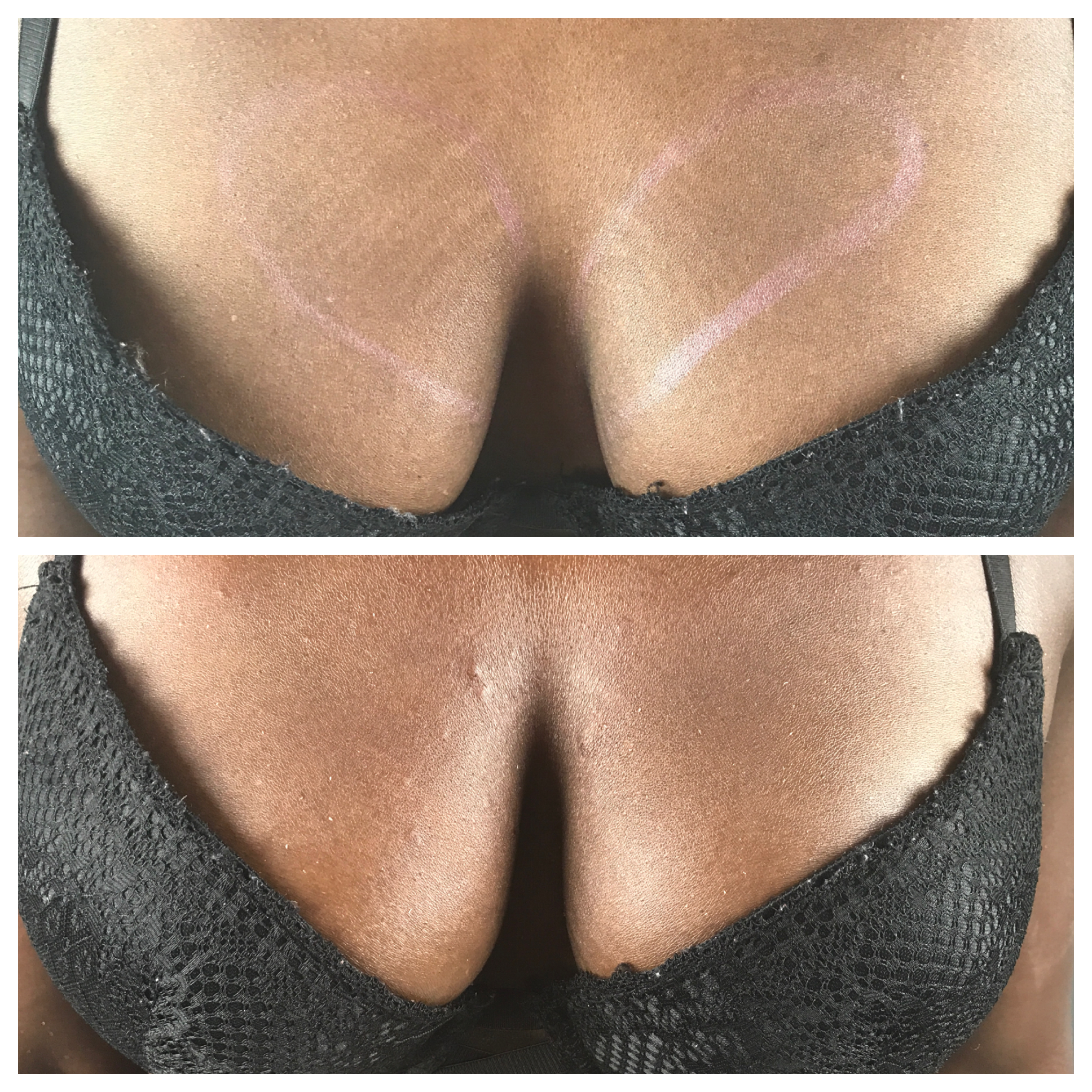 Vampire Breast Lift® Before & After Photos