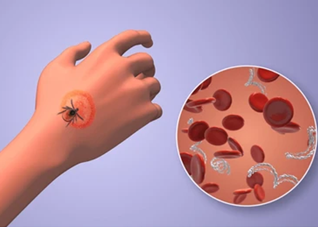 The Overlooked Infections That Complicate Lyme Recovery