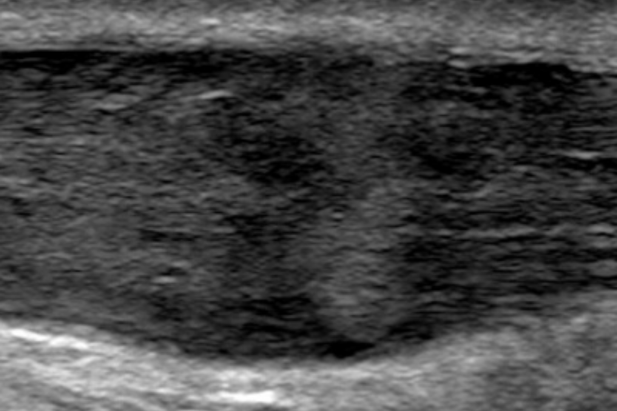 Corticosteroid injections in tendinopathy: why we will continue to follow guidelines.