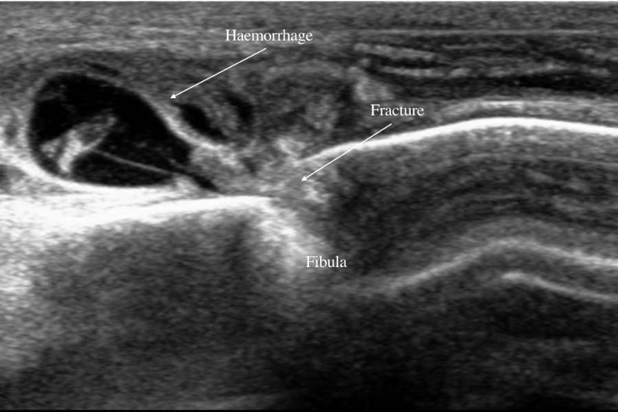 Ankle injury: spiral fibula fracture