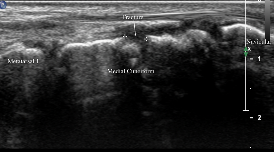 Foot injury: medial cuneiform fracture.