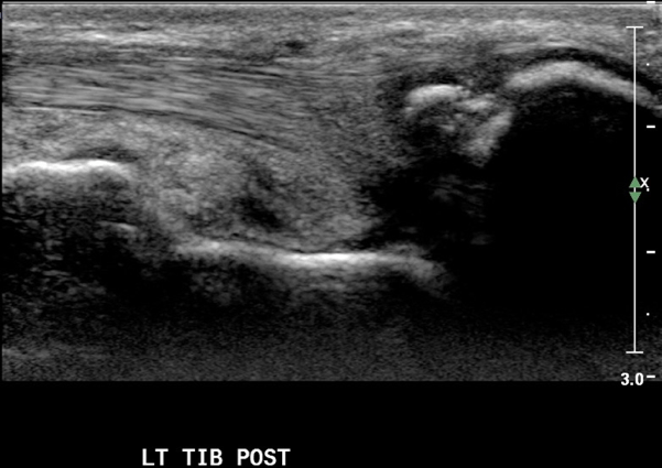 Posterior tibial tendon insertion pain -15 yo male