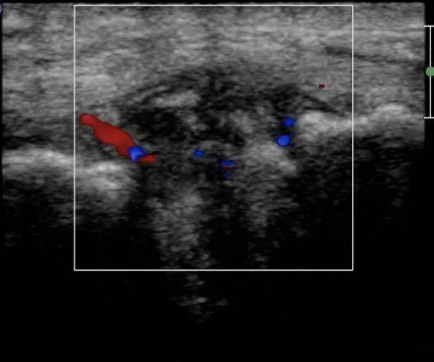 Traumatic isolated Lis Franc ligament rupture - 44 yo female