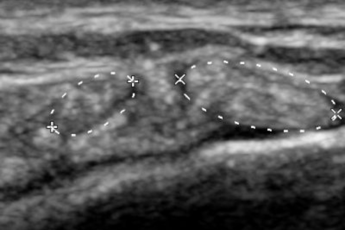 The ankle 2: medial and lateral pain