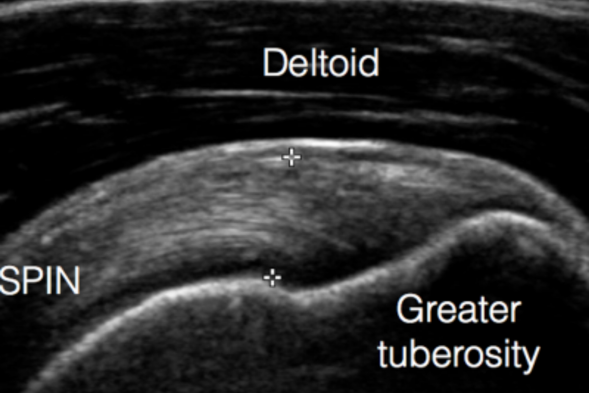 How to tendinopathy: 1