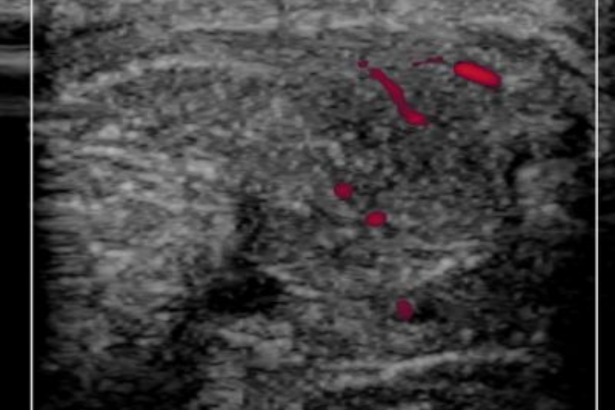 Tendon injury and the continuum. What hurts, and why?