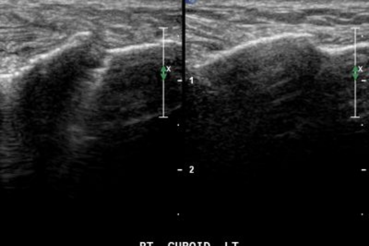 Cuboid fracture: work practices during COVID19 restrictions