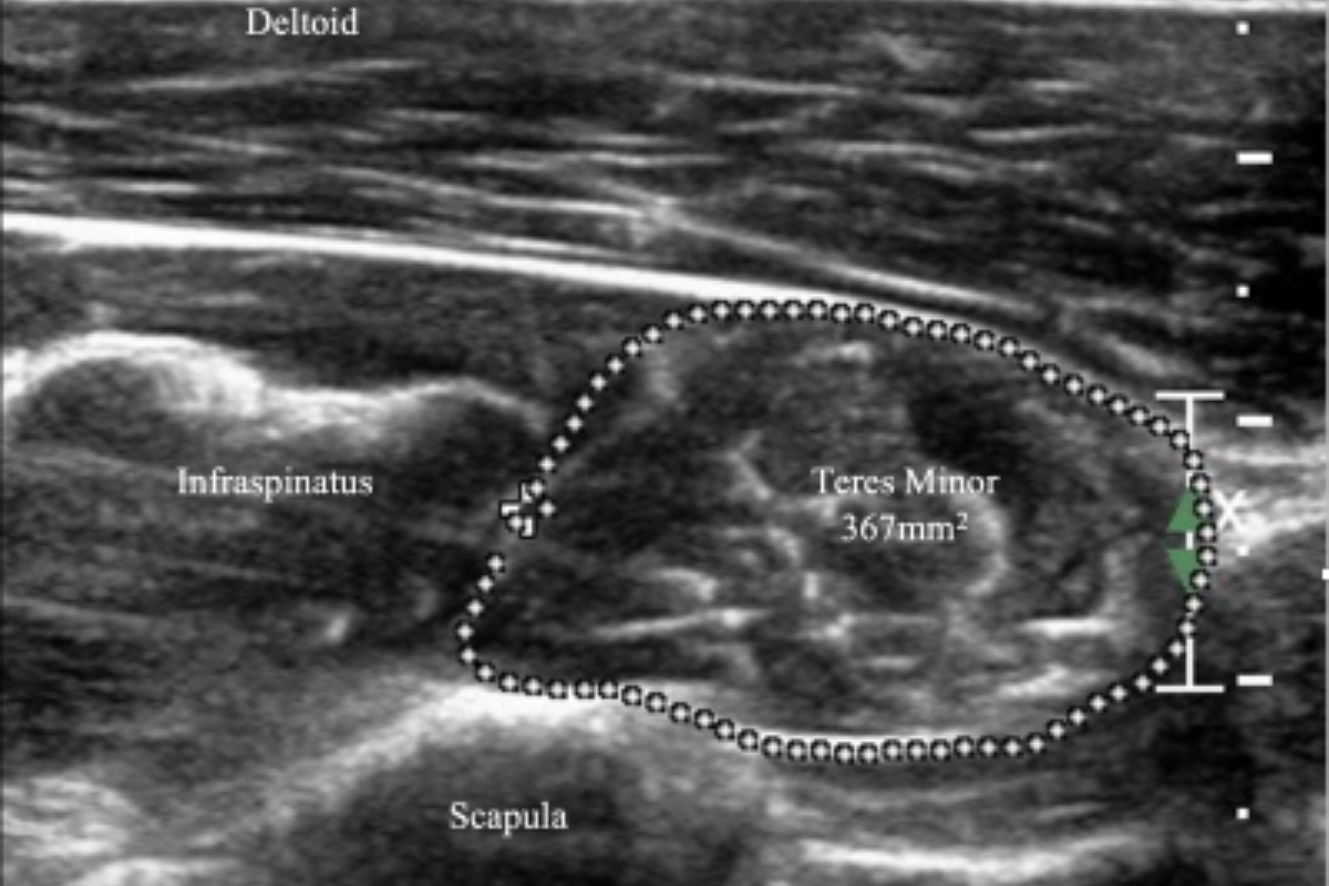 Shoulder pain 2: remember the exceptions
