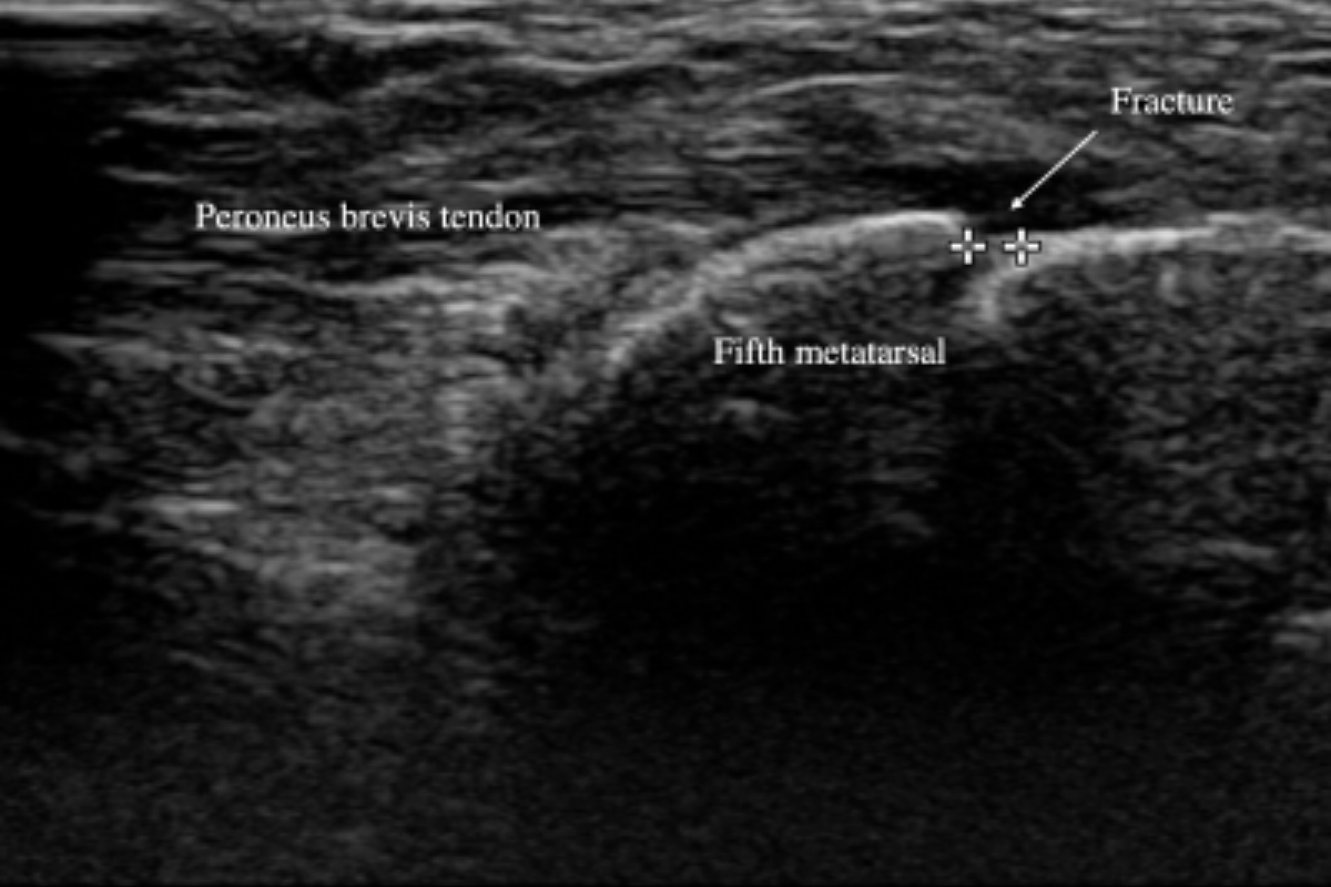 Fractures can be seen on ultrasound. Part 1