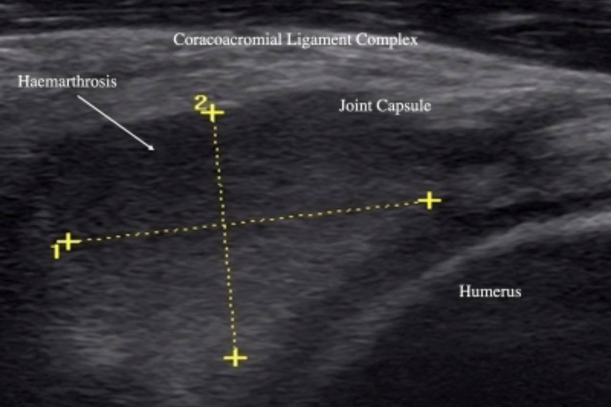 Indicators of intra-articular pathology on ultrasound. Part 1
