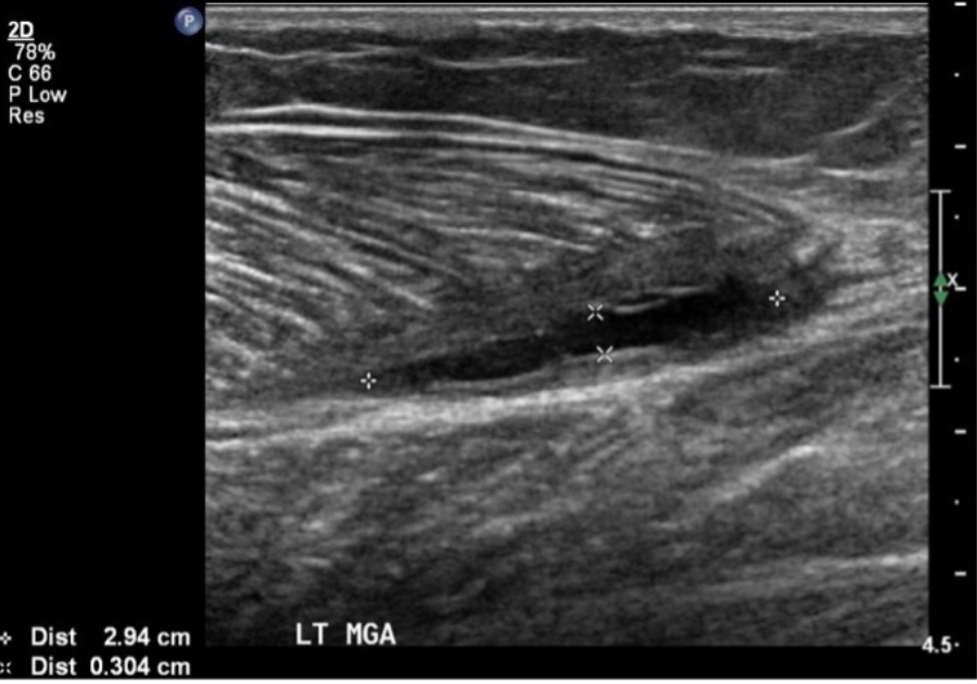 Where do our muscle tear scanning intervals come from? (AKA our promise)