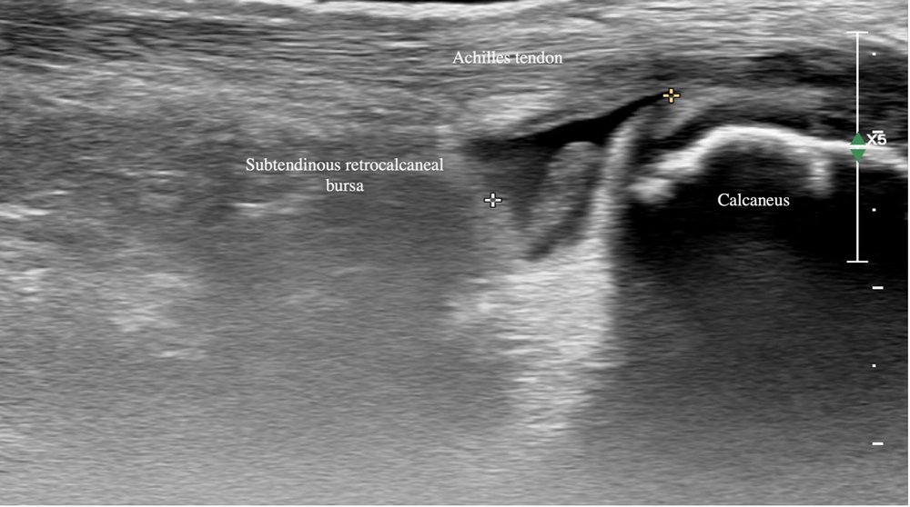 1. Long view of Achilles tendon and insertion