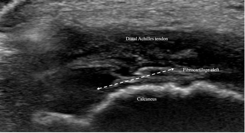 2. Long view of Achilles enthesis