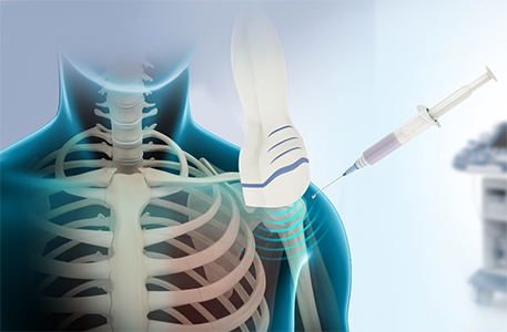 Steroid Injection Information Evening