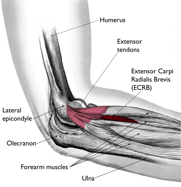 Steroid Injection for CEO Tendinopathy