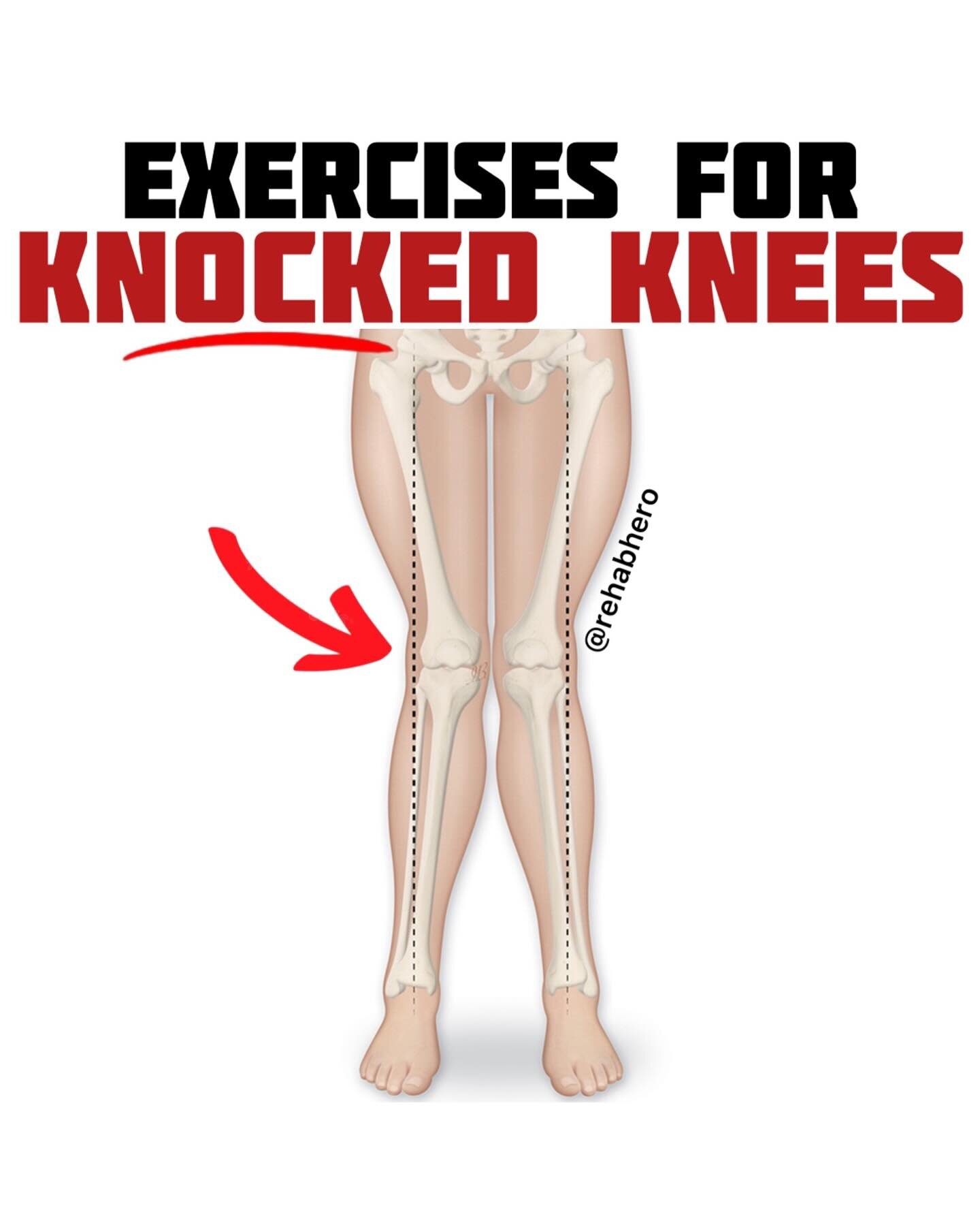 Need to work on knocked knees? I got you ⬇️

Knocked knees don&rsquo;t always cause issues, but sometimes it can lead to pain or soreness. To support the knees working on strengthening the hips can help. Here we are specifically targeting the hip abd